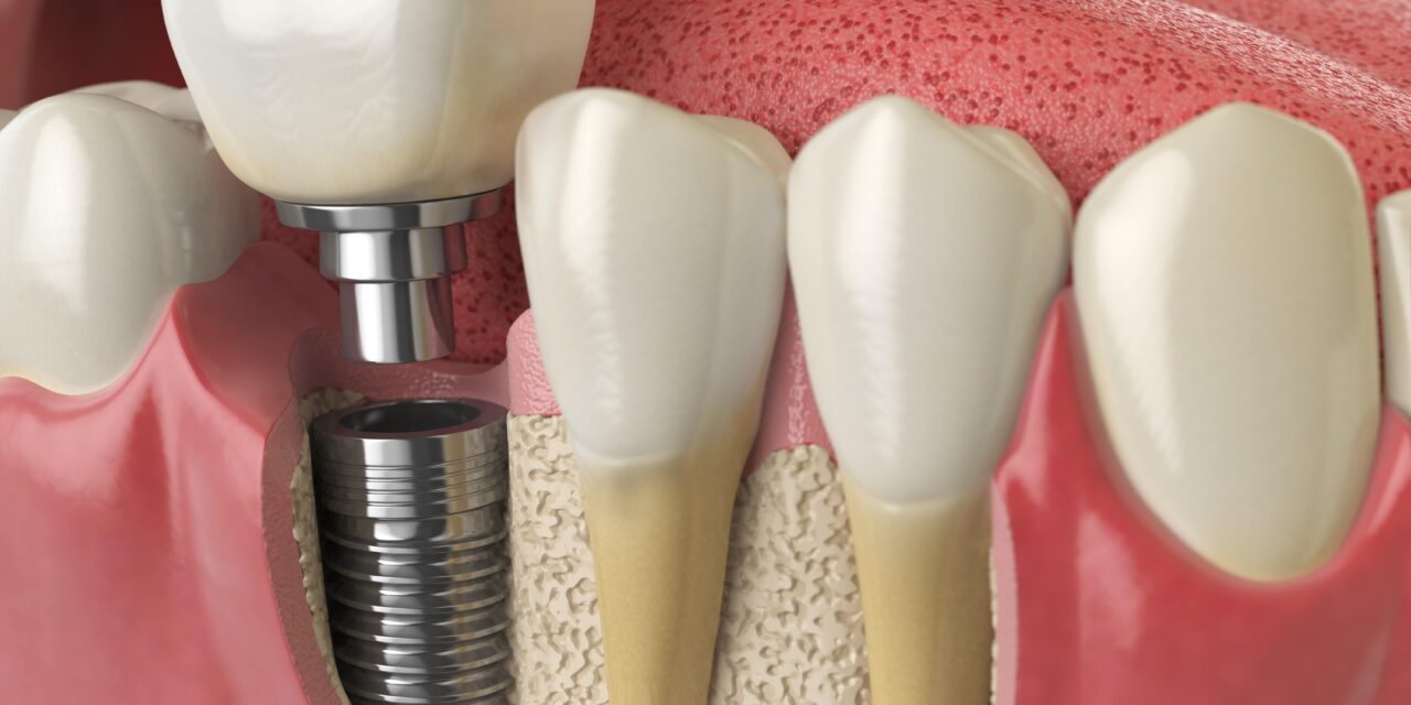 How Long Does It Take to Heal After Dental Implant Surgery?